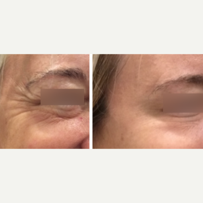 Botox before and after photo