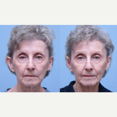 Ear Surgery before and after photo