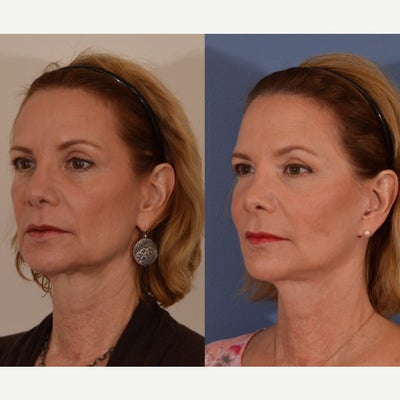Facelift before and after photo