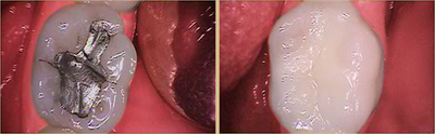 Dental Crown before and after photo