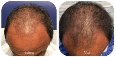 PRP for Hair Loss before and after photo