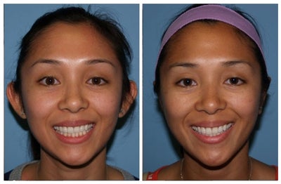 Ear Surgery before and after photo