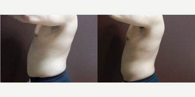 UltraSlim - Man treated with UltraSlim