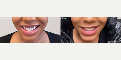 25-34 year old woman treated with Botox for Gummy Smile - This client had a beautiful smile but was hoping for a subtle correction so that less of her gums show when smiling. With precise injections of neuromodulators like Botox or Dysport.