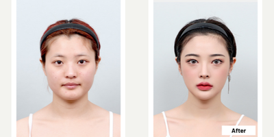 25-34 year old woman treated with V Line Surgery - Shaping Facial Contouring + Revision V-line Surgery