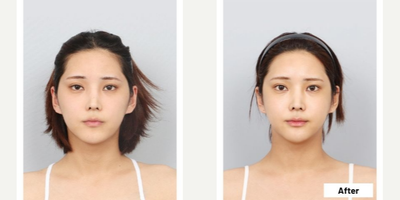 25-34 year old woman treated with V Line Surgery - DA 3 Part Facial Contouring Surgery