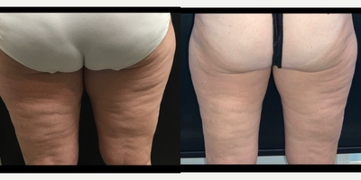 45-54 year old woman treated with truSculpt - One session of TruSculpt ID. 12 weeks apart. Patient could use another 1-2 sessions.