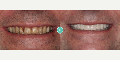 Man treated with Porcelain Veneers - Man treated with Porcelain Veneers