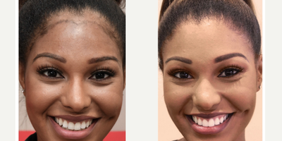 25-34 year old woman treated with Forehead Reduction - 25-34 year old woman treated with Forehead Reduction