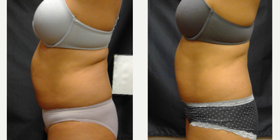 35-44 year old man treated with BodyFX - Patient after 1 treatment.