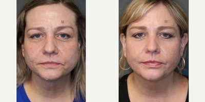 Laser Acne Scar Treatment - Laser acne scar treatment with fractional CO2 laser resurfacing