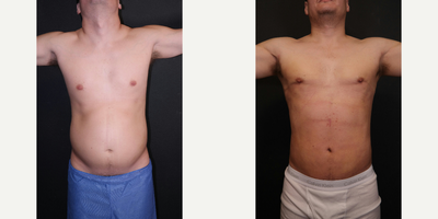 35-44 year old man treated with Laser Liposuction - HD Lipo upper and lower abdomen, flanks and chest