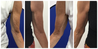 65-74 year old woman treated with Profound RF - Profound has 100% response rate and 37% tightening of skin. Works beautifully to tighten skin on arms.