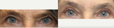 Upper blepharoplasty for sagging upper eyelid skin - The upper eyelid skin was lifted with upper blepharoplasty without fat removal to keep a natural looking fullness above the upper eyelid platform.