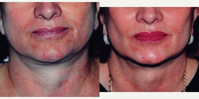 45-54 year old woman treated with Buccal Fat Removal - Buccal Fat removal in our office.