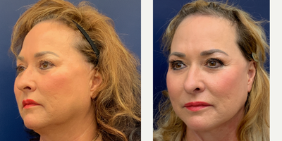 55-64 year old woman treated with Facelift - Facelift with liposuction