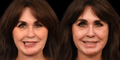 35-44 year old woman treated with Facial Reconstructive Surgery - Before Before & After Selective Neurolysis | Bells Palsy Synkinesis Treatment