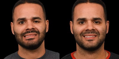 25-34 year old man treated with Facial Reconstructive Surgery - Selective Neurolysis Before & After | Facial Reanimation for Bells Palsy Synkinesis