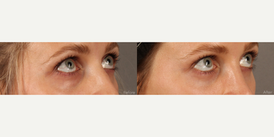Scarless Lower Bleph (Eyelid Lift) with Fat Transfer and CO2 Laser Resurfacing - This beautiful 31-year-old female struggled with lower lid bags that were worsening with age. A transconjunctival (Scarless) lower lid blepharoplasty was performed to reduce the bags. Finesse multi-level fat transfer was performed to create mid-facial and lower lid contours. Fractional CO2 laser resurfacing was performed to tighten and rejuvenate the skin around the eyes.