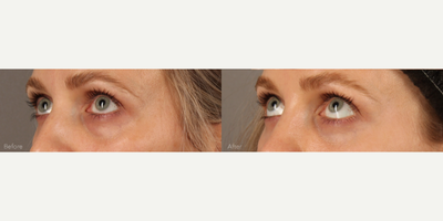 Scarless Lower Bleph (Eyelid Lift) with Fat Transfer and CO2 Laser Resurfacing - This beautiful 31-year-old female struggled with lower lid bags that were worsening with age. A transconjunctival (Scarless) lower lid blepharoplasty was performed to reduce the bags. Finesse multi-level fat transfer was performed to create mid-facial and lower lid contours. Fractional CO2 laser resurfacing was performed to tighten and rejuvenate the skin around the eyes.
