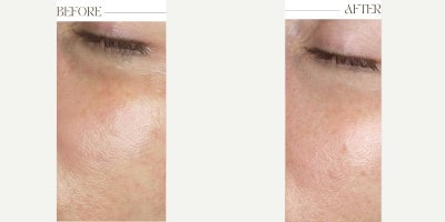 PRF Under-Eye Rejuvenation for Brighter and Smoother Under Eyes (2 Weeks Post-Treatment) - This patient was treated with PRF under-eye injections to improve dark circles, fine lines, and overall skin quality in the under-eye area. PRF (Platelet-Rich Fibrin) is derived from the patients own blood and is rich in growth factors that support collagen production, skin regeneration, and tissue repair.The treatment can also be performed with PRP or a combination of PRP and PRF, depending on the patients needs and goals. At two weeks post-treatment, the under-eye area shows improved skin texture, brighter appearance, and smoother contour, with continued improvement expected over the following weeks as collagen production continues.