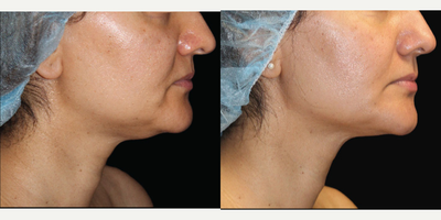 35-44 year old woman treated with Venus Freeze - Post Venus Freeze