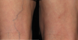 35-44 year old woman treated with Sclerotherapy - Post pregnancy had ugly veins.