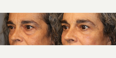 Browlift, upper and Lower Lid Surgery, Fat Transfer - Minimally invasive lower facelift with eyelid surgery
