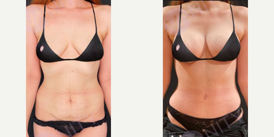 35-44 year old woman treated with Breast Lift, Breast Implants, Tummy Tuck - 35-44 year old woman treated with Breast Lift, Breast Implants, Tummy Tuck