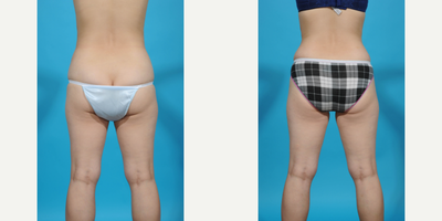 25-34 year old woman treated with Diastasis Recti Repair and Tummy Tuck - Before and after tummy tuck with lipo 360:  This patient demonstrates all 3 components of a standard tummy tuck:  excess skin and fat in the lower abdomen, rectus diastasis, and fat around her waist.  I did a standard tummy tuck with a bikini incision.  3 vector corset muscle plication to flatten her abdomen and cinch in her waist to give her more of an hourglass figure.  I then did VASER ultrasound high def lipo of her waist to give her better contour and a 360 effect.