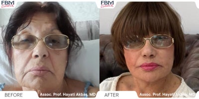 65-74 year old woman treated with Deep Plane Facelift, Facelift, Neck Lift, Facial Fat Transfer, Eyelid Surgery, Lip Lift - 65-74 year old woman treated with Deep Plane Facelift, Facelift, Neck Lift, Facial Fat Transfer, Eyelid Surgery, Lip Lift