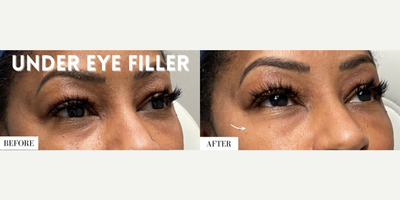 Woman treated with Dermal Fillers - Woman treated with Dermal Fillers