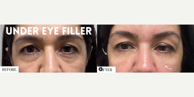 Woman treated with Dermal Fillers - Woman treated with Dermal Fillers