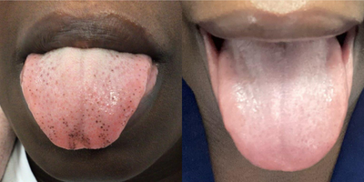 25-34 year old woman treated with Laser Peel - 2 weeks after PICO PLUS laser treatment for Pigmented Papillae of the Tongue