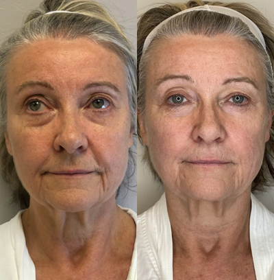 65-74 year old woman treated with Secret RF - Female patient before and after Secret RF with PRP