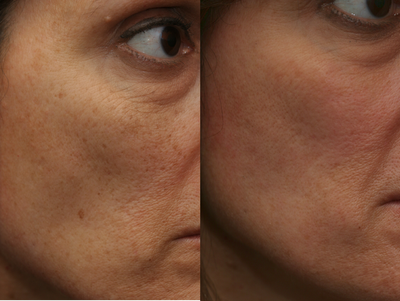 Portrait PSR3 Plasma Skin Resurfacing - After treatment this patient has skin that is the color it was when she was a teenager.