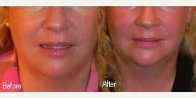 Woman treated with Kybella - Woman treated with Kybella