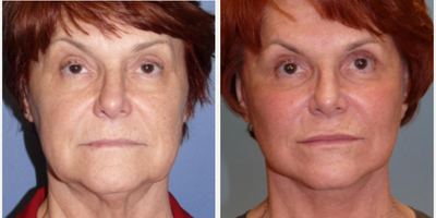 Woman treated with SMAS Facelift - Woman treated with SMAS Facelift, Neck Lift, and Facial Fat Transfer to rejuvenate cheeks, jowls, and neck.