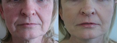 45-54 year old woman treated with Fractional Laser - Full face fractional carbon dioxide laser resurfacing