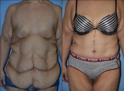 35-44 year old woman treated with Tummy Tuck - This patient in her late thirties had a Fleur De Lis Abdominoplasty following 300lbs of weight loss.The photos of her incredible transformation are shown 7 months post op.