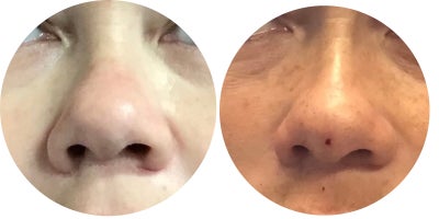 35-44 year old woman treated with Thread Lift, Contour Thread Lift - The patient is in her late 30s. The patient desired a slimmer nasal profile with improved tip projection while avoiding surgical rhinoplasty. A non-surgical nose enhancement was performed using threads to refine the dorsum and subtly elevate the tip. Immediate post-procedure results demonstrate improved contour, better definition, and a more balanced profile. The outcome maintains natural proportions while enhancing structural support.