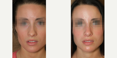 Woman treated with Rhinoplasty - Woman treated with Rhinoplasty