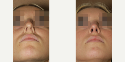 Woman treated with Rhinoplasty - Woman treated with Rhinoplasty
