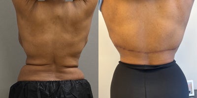 55-64 year old woman treated with Back Lift - 59 yo s/p back lift/ bra line lift performed in our on site AAAA certified operating suite.