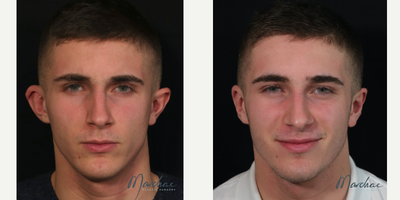 25-34 year old man treated with Secondary Otoplasty using Earfold - This really nice fireman had an otoplasty at the age of 10 years old and he was unhappy with the result. I improve the harmony of his ears using a combination of treatments: Earfold + remodeling the helix.I find Earfold to be particularly interesting in adult patients who want to have limited downtime. He went back to his fire station on day 2 after his procedure without having to wear a head band.