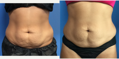 35-44 year old woman treated with Evolve - 42 yo female - mother of 2 kids - received 3 sessions of Evolve Tite around the abdomen (weekly over 1 month). No Downtime or bruising.