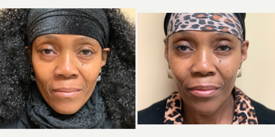 Liquid Facelift - Treatment with Threads, Botox, and Fillers