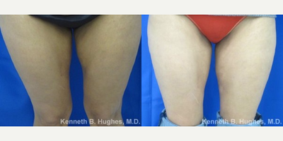 Liposuction Revision - This patient had liposuction of the medial thighs that left dents in the middle portion of her inner thighs. Dr. Hughes fixed this area with fat transfer of about 120 cc of fat to each leg.
