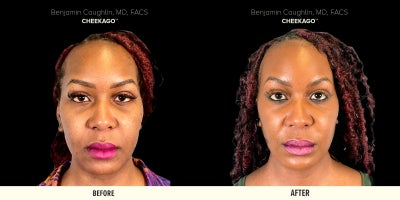 25-34 year old woman treated with Buccal Fat Removal, Chin Implant, Facial Fat Transfer, Jaw Surgery - 25-34 year old woman treated with Dr. Caughlin's signature Cheekago