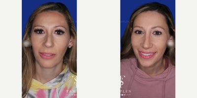 Woman treated with Revision Rhinoplasty - Woman treated with Revision Rhinoplasty